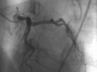 Left coronary artery angiogram