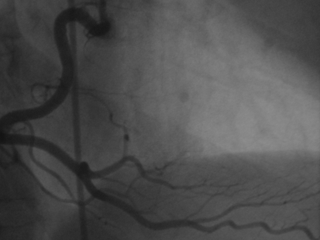 Right coronary artery angiogram